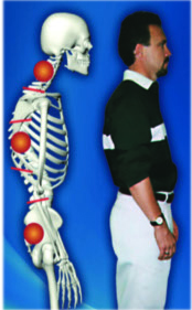 A photograph of a man with an excessively curved back, next to an illustration of a skeleton with vertebra at incorrect angles.